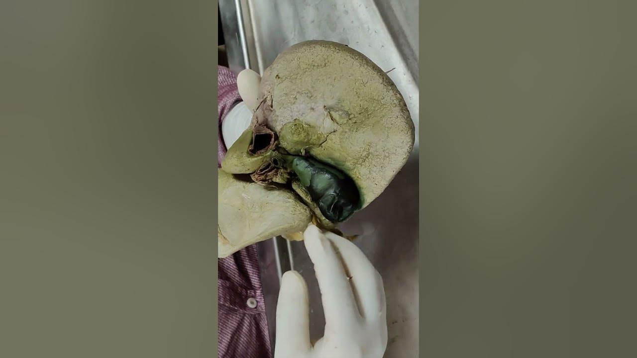 Where Is Gallbladder Located Picture