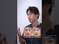 クマ取り▶30代男性(痩せ型の顔立ちの方)