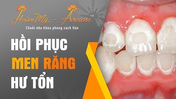 Các Phương Pháp Hồi Phục Men Răng - Nha Khoa Hoàn Mỹ
