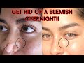 GET RID OF A BLEMISH OVERNIGHT! (for emergencies/special occasions)