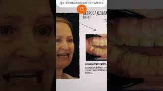 Полный ролик по ссылке выше ^ #имплантациязубов #зубныепротезы