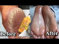 How to remove dead skin from your feet naturally at home 2021| cracked heels home remedy | Zondi M