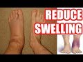 How to Reduce Swelling: Make Your Swelling Go Down Easy Methods