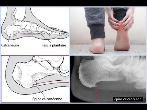 Vidéo n°155: L'épine calcanéenne - YouTube