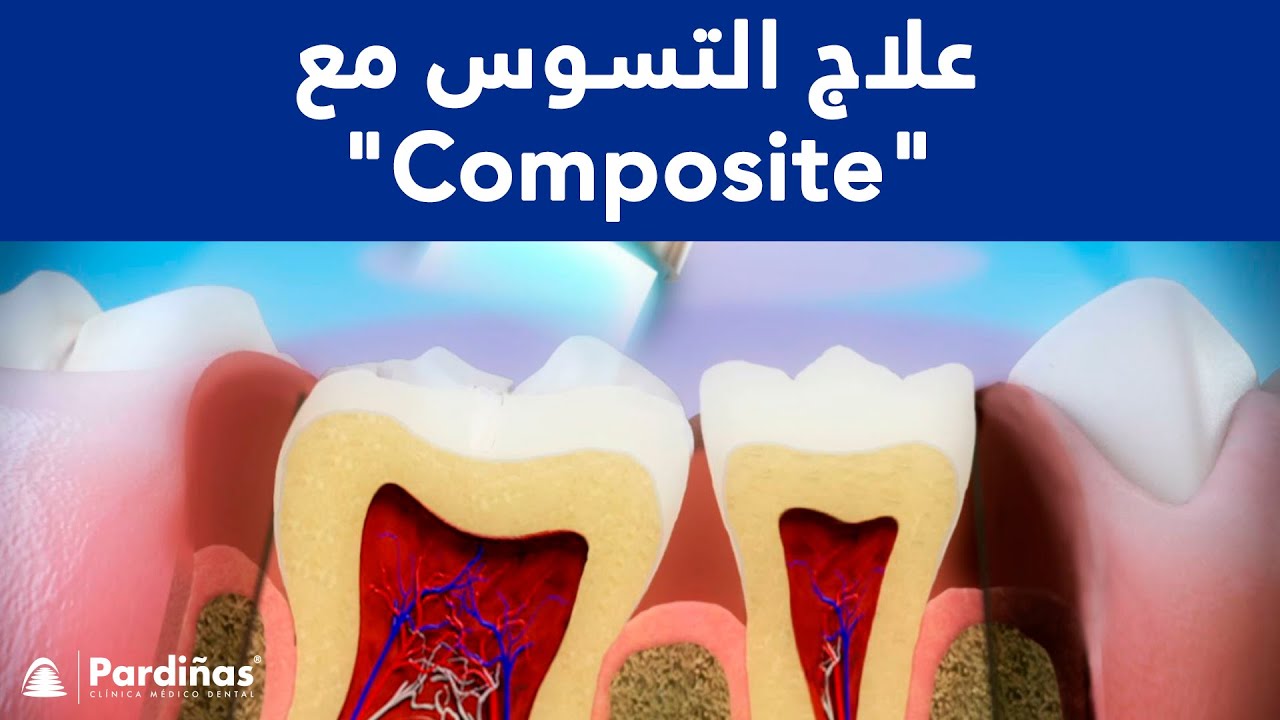 علاج التسوس - Composite restoration © - YouTube