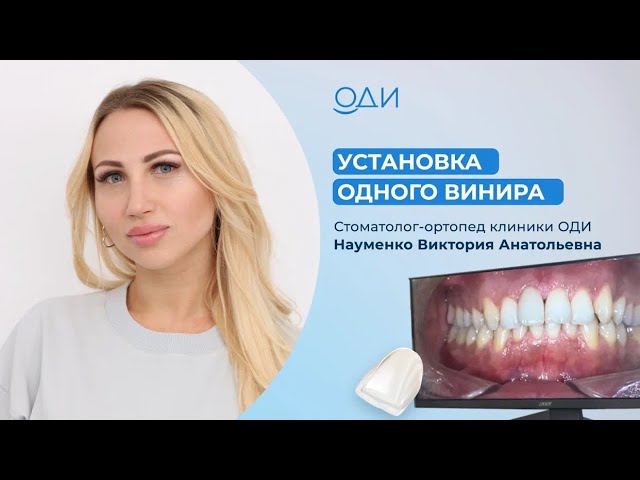 Можно ли поставить винир на 1 зуб?