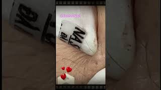 Relax Blackhead Removal 089  shorts  blackhead  acne  pimplesremoval  satisfying