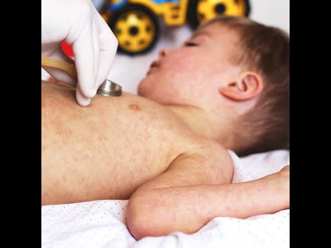 Video: De ce roseola este contagioasă?