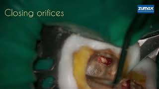 Perforation Repair. Dr. Adeeb Ismail screenshot 2