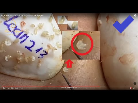 BLACKHEADS EXTRACTION (213) | Loan Nguyen