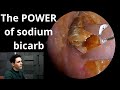 Sodium bicarbonate drops vs earwax  dead skin