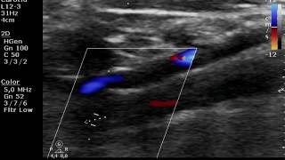 Видео Окклюзирующая диссекция ВСА - клинический случай (автор: Наталья Кривенок)