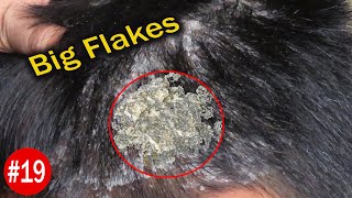 Scratching Huge Flakes - Huge Dandruff Removal On My Nephew Head Big Flakes