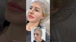 Щёчки-яблочки, скулы, средняя треть! 3мл на все лицо 😘💉 #контурнаяпластика #cosmetology