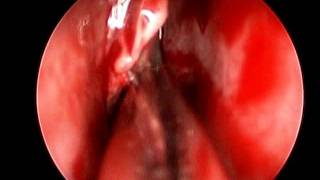 Nasal Polyp Surgery With Microdebrider