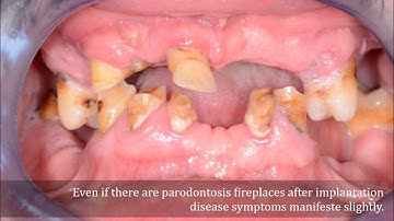 Total restoration of the jaw with Straumann implants. Pro - arch methodology