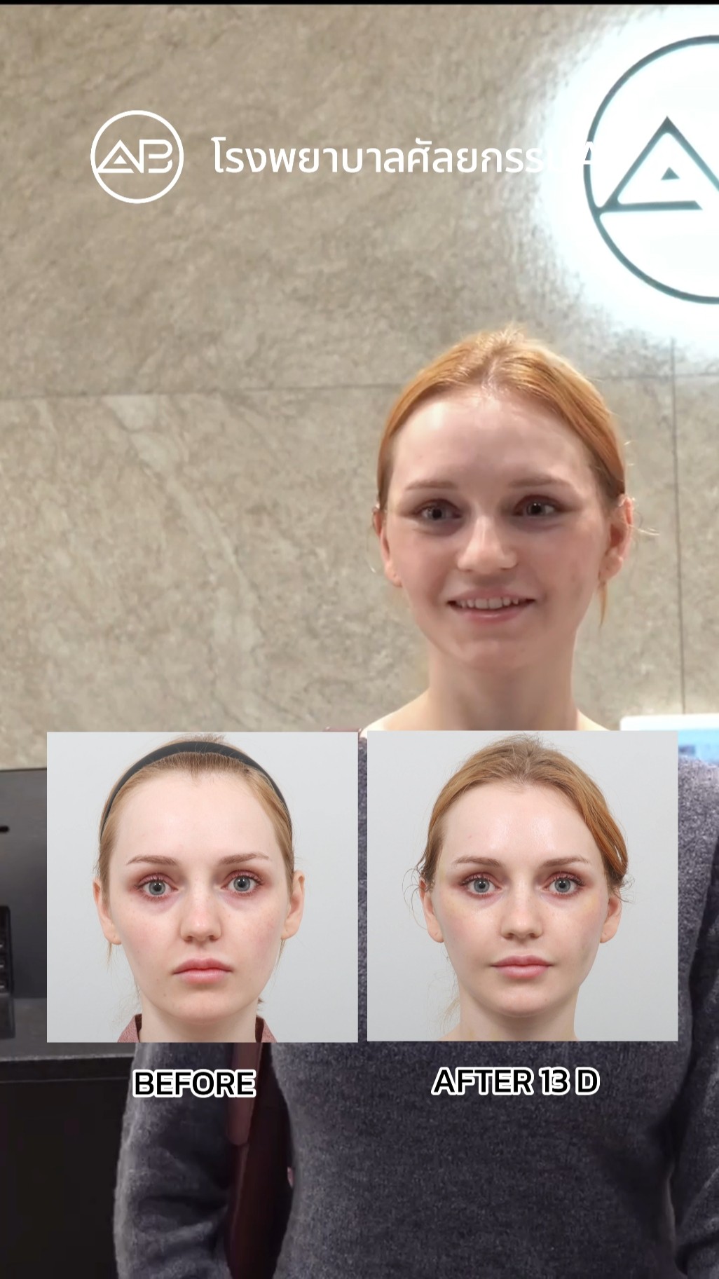 Effortless Beauty Enhancement: Semi Facelift Transformation!