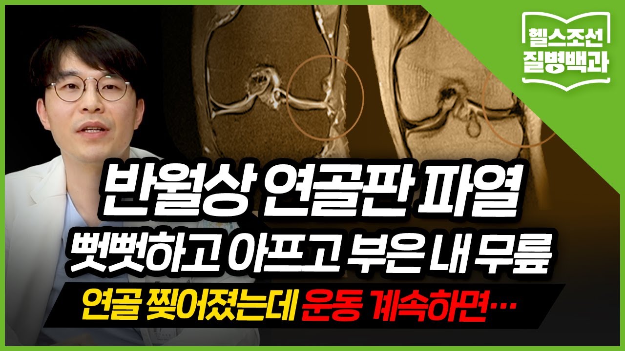 [반월상 연골판 파열] 연골 찢어져도 걸을 순 있지만… 방치하면 봉합도 불가능