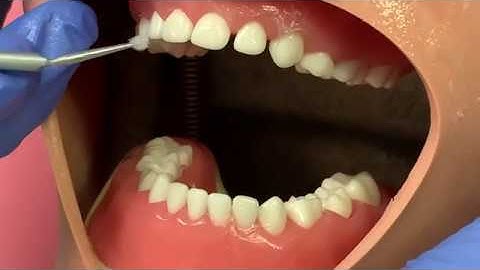 How to apply Silver Diamine Fluoride