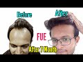 Amazing Hair Transplant Result (2020) | Hair Transplant in india