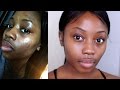 How to: get rid of acne scars morning routine 2016 | Lizzie loves skincare