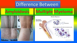 Difference between Amyloidosis and Multiple Myeloma