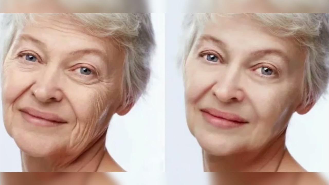 Измениться в 60 лет. Возрастная кожа лица. Морщины на лице. Морщины до после. Мимические морщины.