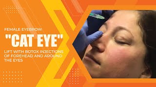 FEMALE EYEBROW 'CAT EYE' LIFT WITH BOTOX INJECTIONS OF FOREHEAD AND AROUND THE EYES | Dr. Jason Emer
