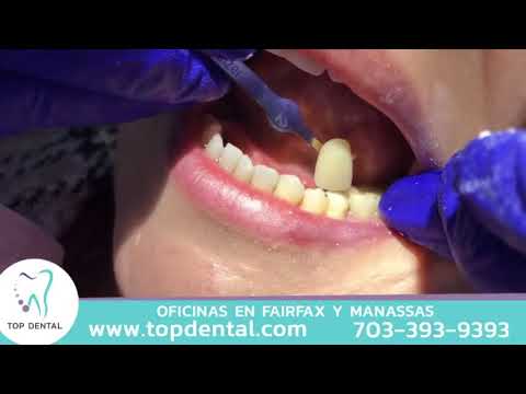 ¿Cómo se coloca una corona dental? | Top Dental