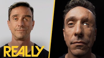 Man Whose Face Was "Peeled Off The Bone" Receives Eyebrow Prosthetics | Body Parts