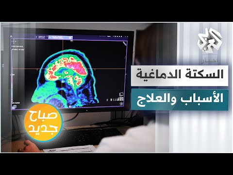 فيديو: أثناء السكتة الدماغية؟