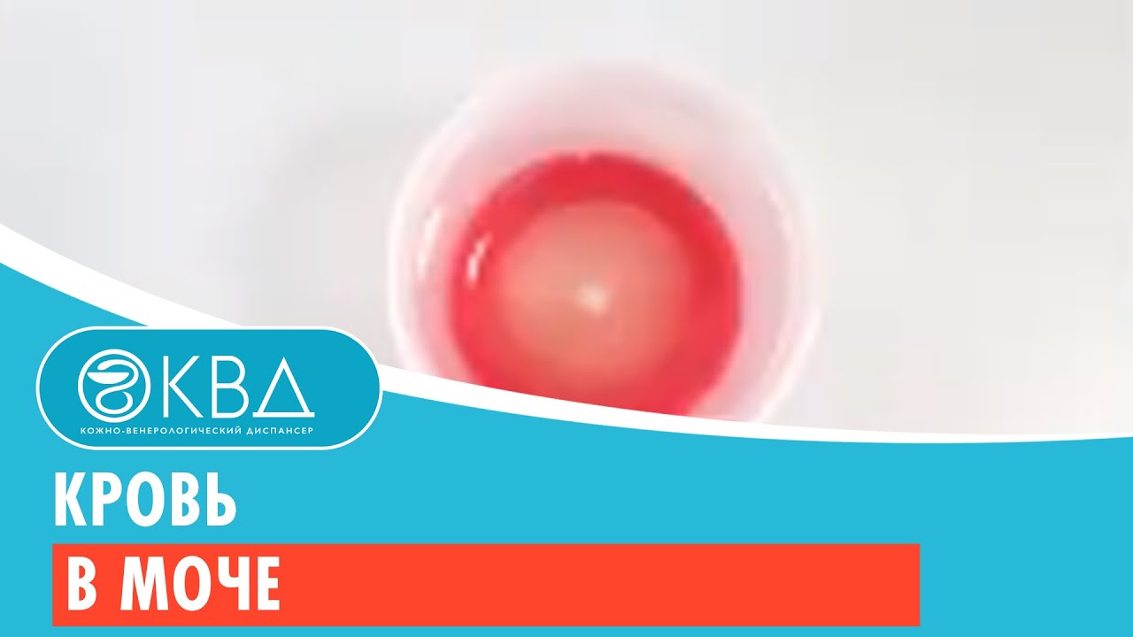 Кровь в моче. Клинический случай №54