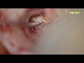 Right Facial Nerve Decompression of Horizontal Part of Facial Nerve done by Dr.Meenesh Juvekar.
