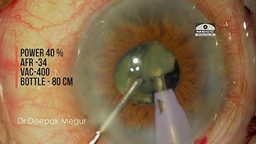 Phacoemulsification in an eye with small pupil - Understanding strategies , Dr Deepak Megur
