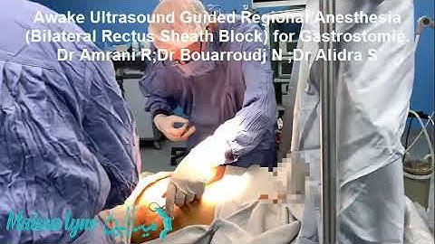 Awake Ultrasound Guided Regional Anesthesia (Bilateral Rectus Sheath Block) for Gastrostomie