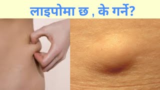 Lipoma in Nepali| Dr Bhupendra Shah|doctor Sathi