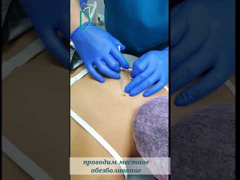 Удаление родинок (невусов) в Запорожье