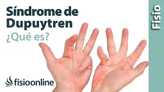 Síndrome o enfermedad de Dupuytren - Qué es, causas, síntomas y tratamiento
