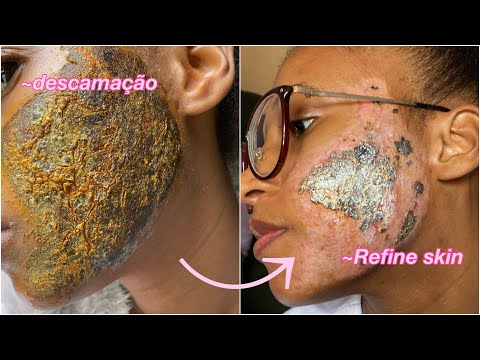 Cicatrizes de acne