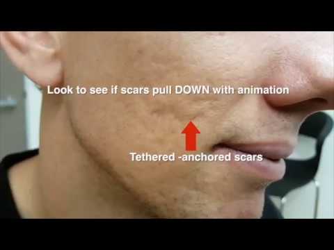 ACNE SCARS - subcision
