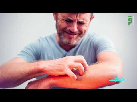 وصفات منزلية لعلاج قرصات النمل طابت صحتكم