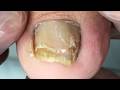 Toenails are severely decayed and layered, layer by layer trimming &amp; care【DrZhang】
