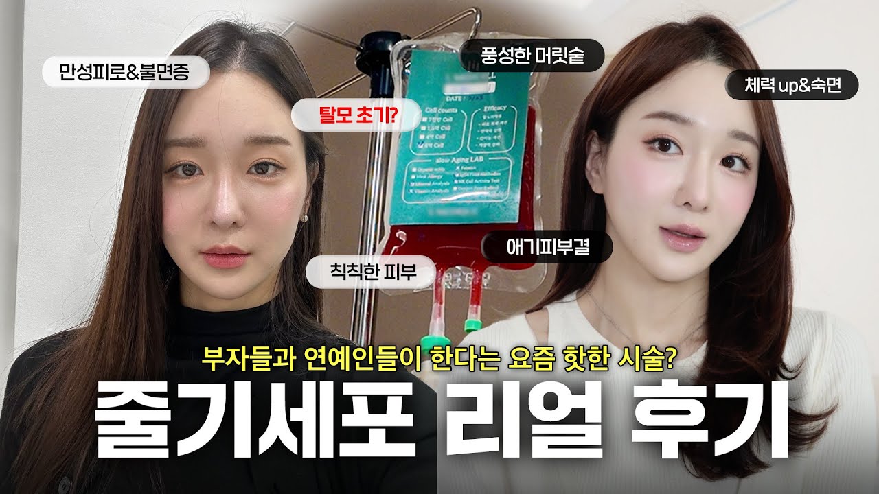 부자들이 몰래 맞는다는 줄기세포 후기! 얼굴, 두피주사까지 맞았는데 효과 미쳤어요...🫨 10년 전 체력, 탈모 치료, 애기 피부는 덤👼🏻