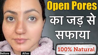 OPEN PORES *खुले रोमछिद्रों* Large Pores,Clogged Pores Treatment at Home | 100% Crystal Clear Skin💕 screenshot 3