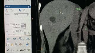 "أهمية وظيفة الوحدة الاستشعارية او HU او هاونسفيلد  في الأشعة المقطعية في تشخيص الأمراض" screenshot 4