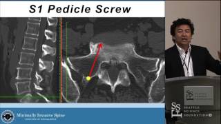 Minimally Invasive Posterior Instrumentation - Choll W.  Kim, MD PhD