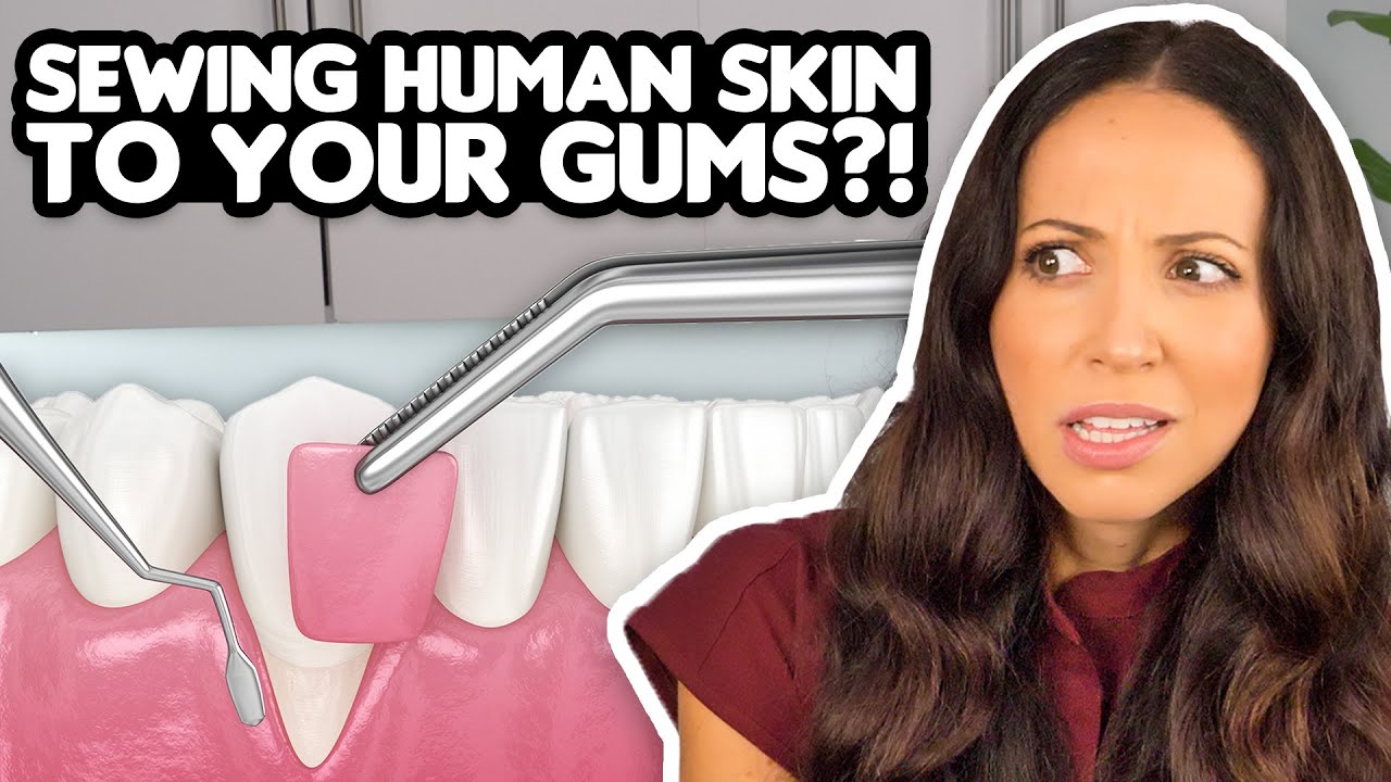 Outline Video Gum Grafts Explained