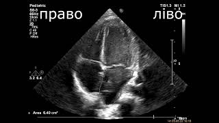 Протокол оцінки ЕхоКГ у дітей (норма)