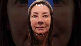 Preservation Rhinoplasty at W Facial Aesthetics - 1 Week Reveal!