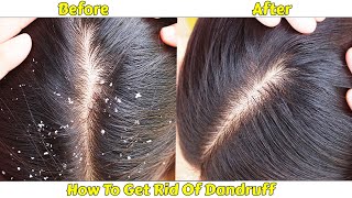 How To Get Rid Of Dandruff/Dandruff Medical and Home Remedies/Dandruff Removal